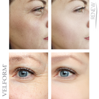 Parches solubles colágeno y ácido hialurónico para el rostro